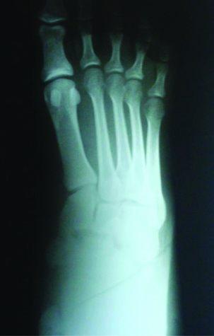 Moreira ET, Andrade CA, Maluf Neto J, Lovisotto LA Figura 2 - Radiografia do pé esquerdo, in cidência anteroposterior.