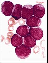 Lymphoblastic Leukemia (ALL) vs Acute