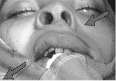 Formou-se um pilar muscular de cada lado do nó na incisão intra-oral correspondentes aos músculos abaixadores do septo nasal.