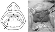 (Figura 6). FIGURA 6 - Sutura em duplo-u, utilizando fio monofilamentar inabsorvível agulhado 3-0. A - identificação da implantação profunda da asa nasal esquerda.