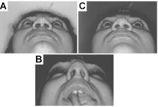 SANTANA (1991) (6) ao descrever a técnica de rinoplastia de nariz negróide sem ressecções externas pela via de Caldwell-Luck, relatou que obteve resultados satisfatórios, embora não tenha detalhado o
