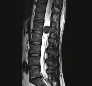 A RM da coluna lombar revelou uma lesão expansiva intradural extramedular a nivel de L1, com remodelação do canal de conjugação L1-L2, isointensa em T1 e iso/hipointensa em T2, com reforço homogéneo