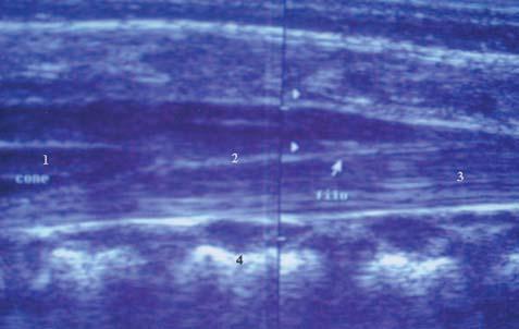 ecóico central; 3) dura-máter; 4) corpo vertebral; 5) processo