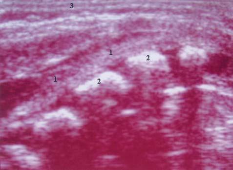 3) cauda eqüina; 4) corpo vertebral. Fig 3.