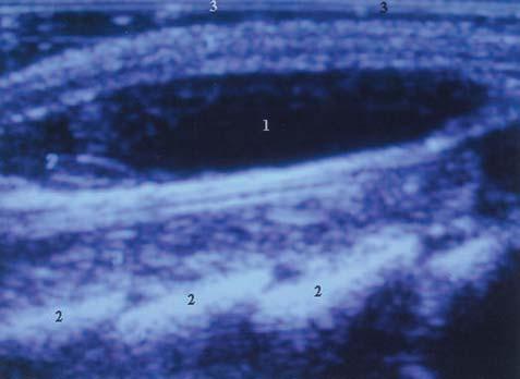 Cisto: 1) cone medular; 2) raízes nervosas; 3) cisto; 4) processo espinhoso; 5) corpo vertebral; 6) dura-máter.