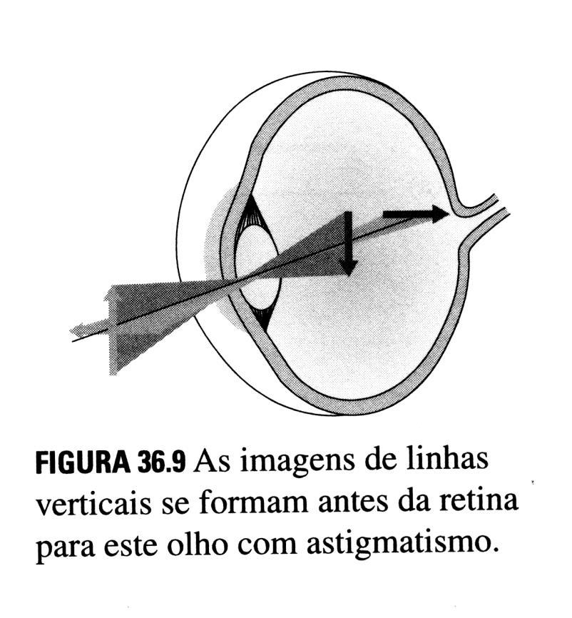 Problemas de acomodação e correção Córnea ou cristalino, não são