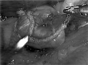 140 Tinoco et al. Cirurgia da Obesidade Mórbida Figura 4 Bigorna do stapler circular CEEA dobrada e fixada ao cateter nasogástrico. Figura 2 Posição dos trocartes de 11-12mm e 5mm.