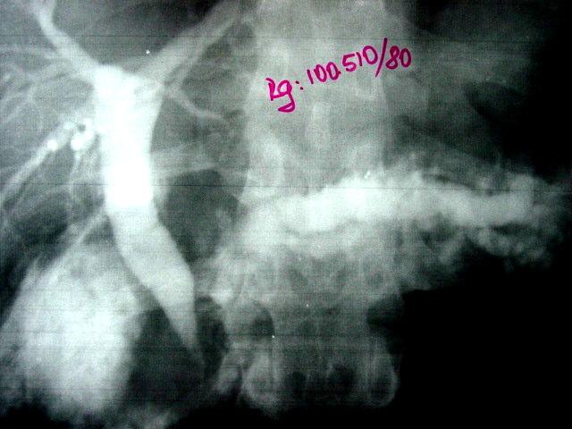 PANCREATITE CRÔNICA - TRATAMENTO CIRÚ