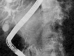 PANCREATITE CRÔNICA - TRATAMENTO CIRÚ PROCEDIMENTOS CIRÚS S