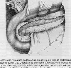 em V do pâncreas ventral Pancreatite crônica de ducto pequeno