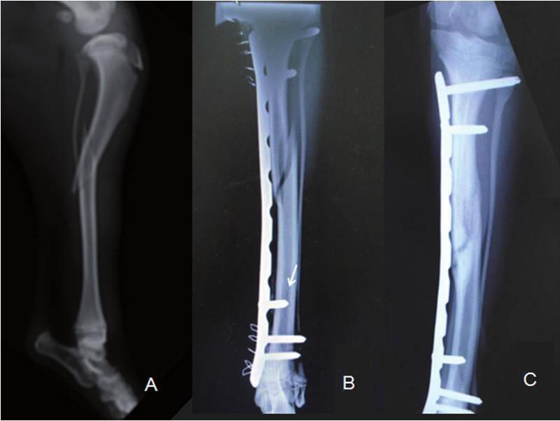 516 importante em fêmur distal. Para correção, procedeu- -se à ostectomia em cunha, em fêmur distal, e a fratura foi estabilizada com POB, sendo quatro parafusos proximais e dois distais.