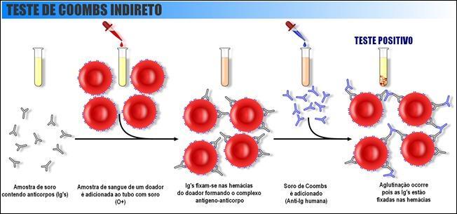 TESTE DE COOMBS INDIRETO Um soro que contenha anticorpos incompletos é incubado com hemácias que contenham o antígeno correspondente As hemácias assim