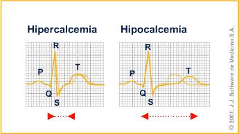 impossível de ser determinado. Onda T impossível de ser determinada Intervalo QT não aplicável Outros - desfibrilação elétrica bem sucedidas, Indica hipoxemia e acidose mais avançadas.