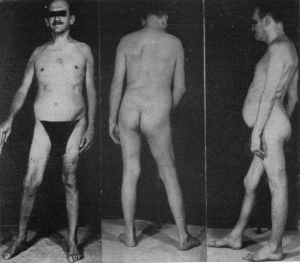 Hitzig (1888) e Oppenheimer (1888), todos citados por Wohlfart 24, reportam fasciculações como integrantes do quadro clínico de distrofia muscular progressiva.