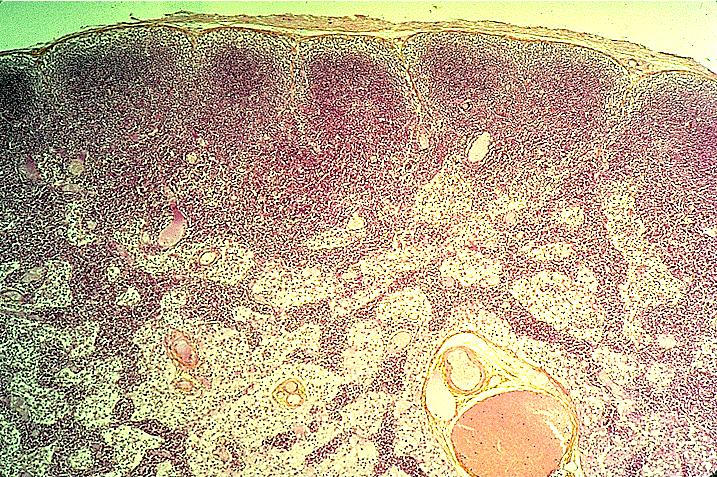 medular seios peritrabeculares