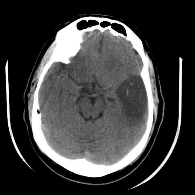 hiperdensa é observado em cerca de 35% dos pacientes com sintomas de infarto agudo da artéria cerebral média e pode prever um maior volume de infarto. Figura 2.