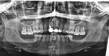 O exame anatomopatológico confirmou o diagnóstico de lesão cística, compatível com cisto periapical residual.