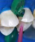 A B C D E F Figura 14 A) Segundo pré-molar superior com restauração inadequada devida à ausência de ponto de contato.