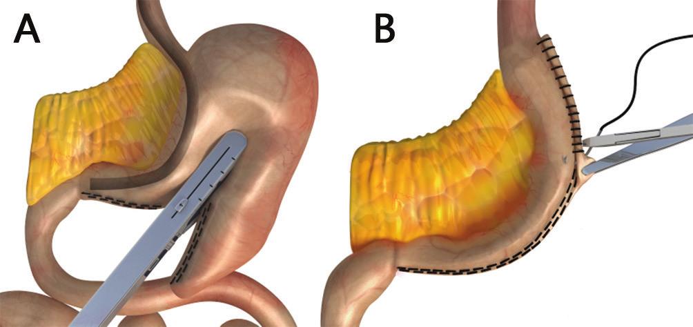 refluxo; refere ainda que o bypass gástrico em Y-de-Roux melhora os sintomas préexistentes de DRGE na maioria dos pacientes. A técnica da gastrectomia vertical ainda não foi totalmente padronizada.