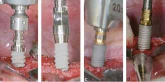 Immediate implants at fresh extraction sockets: bone healing in four different implant systems. 8 de Sanctis M, Vignoletti F, Discepoli N, Zucchelli G, Sanz M. J Clin Periodontol 2009;36(8):705 711.