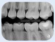 Endo - PSP tamanho 0 Oclusal - PSP tamanho 4 Implante