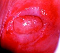 Aspecto colposcópico do colo uterino norml Ô vsculres crcterístics do epitélio metplásico compreendem vsos regulres rmificdos longos com clire grdulmente menor e um rede de vsos regulres rmificdos