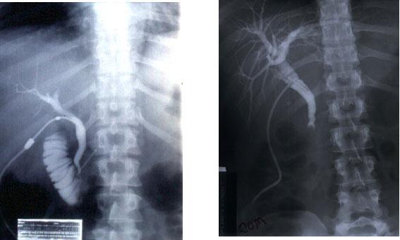 Medicina (Ribeirão Preto) 2008; 41 (4): 429-44. Colecistectomia: aspectos técnicos e indicações para o tratamento da litíase biliar e das neoplasias http://www.fmrp.usp.