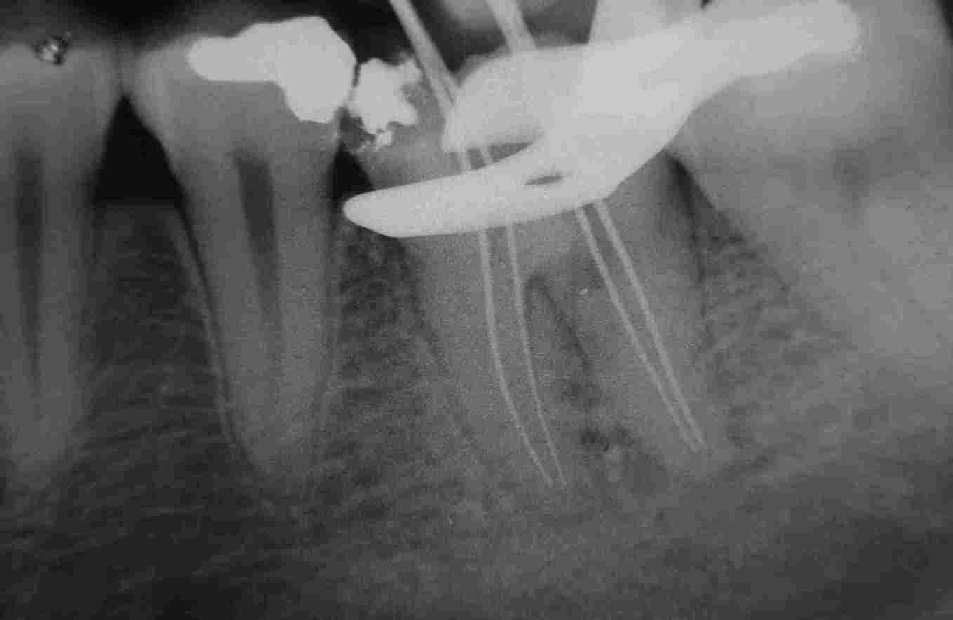 Na radiografia inicial verificou-se uma rarefação óssea difusa no ápice das raízes mesiais e distais.