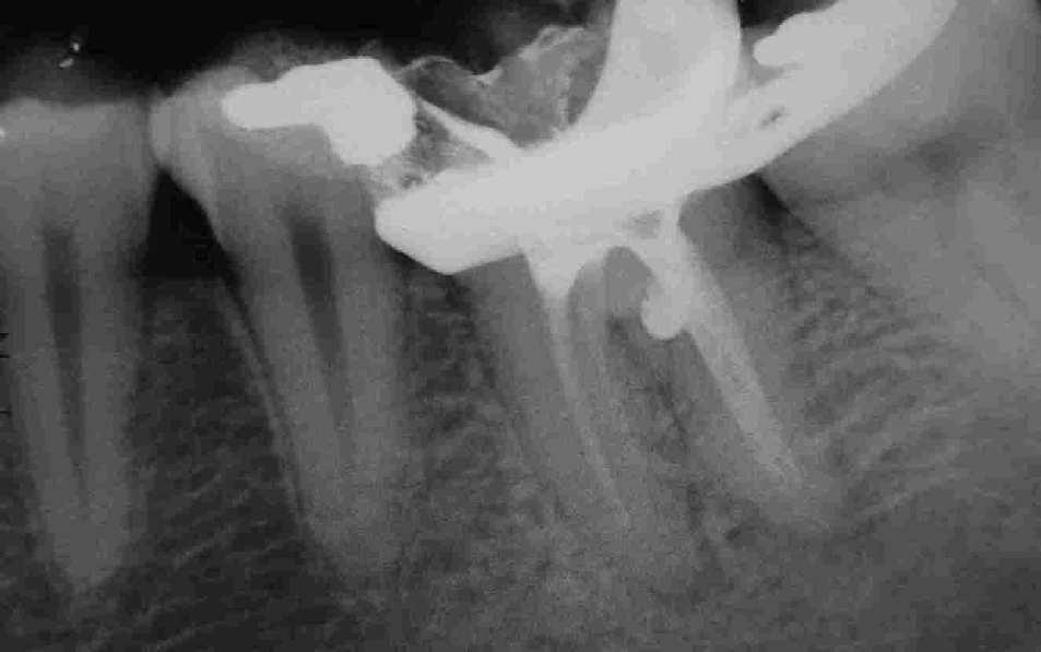 e plastificar os cones de guta-percha, para que esta possa preencher o espaço criado pela reabsorção.