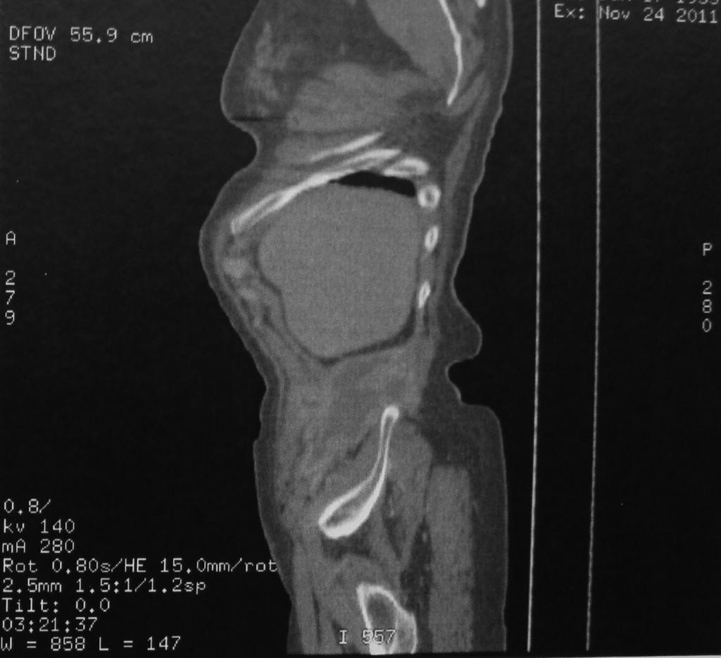 Figura 2: Tomografia computadorizada, corte sagital, mostrando formação complexa, com realce periférico e componentes intra-abdominal, em parede abdominal e tecido subcutâneo.