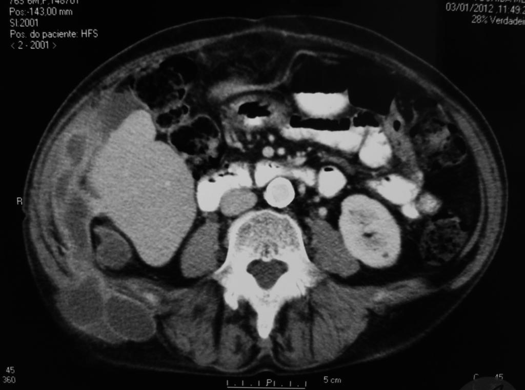 Figura 3: Tomografia computadorizada de controle, corte axial, evidenciando aumento do conteúdo herniado através do triângulo lombar superior.