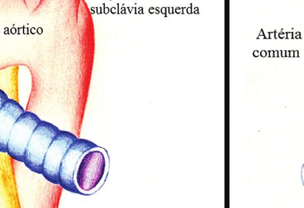 As principais razões que impossibilitaram a avaliação da artéria subclávia direita (n=38) na ecografi a do primeiro trimestre foram: o elevado IMC (r=0,5; p<0,001) e o menor tempo de gestação/ccc