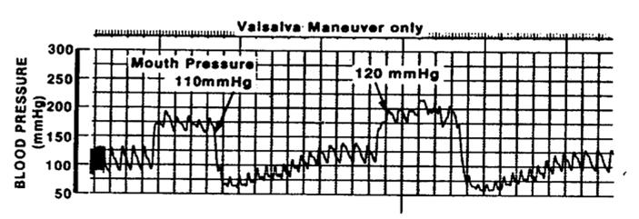 Manobra de Valsalva Resposta da PA à Valsalva Apneía respiratória concomitante a uma tentativa de expiração com a manutenção da glote fechada Resulta em aumento da Pressão Intratorárica