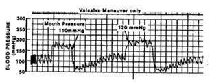 SEGURANÇA VASALVA MANOBRA DE VALSAVA Pressão Intratorácica PAS PAD Pressão Cérebro Espinhal Pressão Transmural Protege Cérebro EVITAR FAZER Valsalva + Exercício PA = Valsalva + exercício