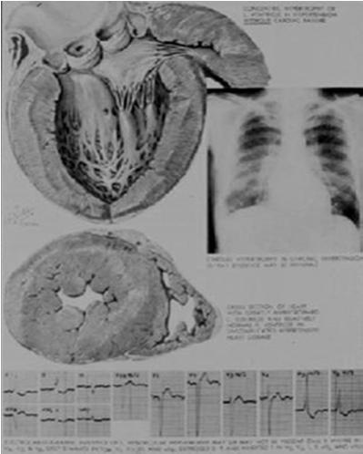 Hipertrofia Cardíaca Doença da Artéria Coronária Insuficiência