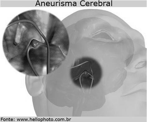 Cardíaca Infarto LESÃO DE ÓRGÃOS- ALVO Aneurismas Infartos Lacunares