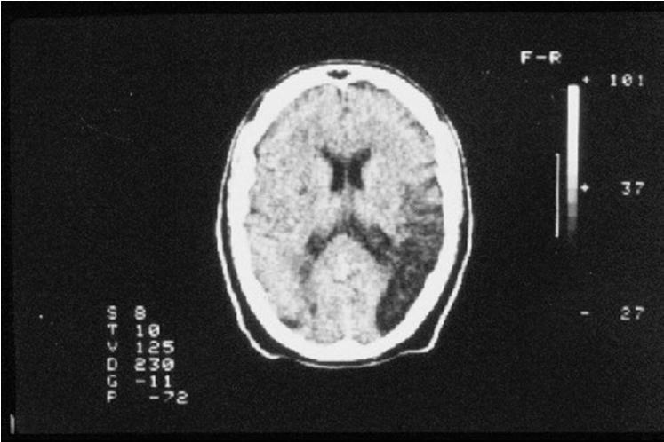 MORTALIDADE AVC x HIPERTENSÃO Seventh Report of JNC on Prevention, Detection, Evaluation and