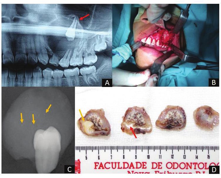 Tumor odontogênico Atendimento adenomatoide: odontológico relato de um caso domiciliar clínico destacando ao idoso e a os necessidade seus principais de tratamento diagnósticos endodôntico