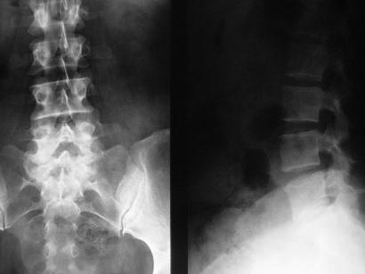 270 Rossanez JR, Costa RBL, Camargo Junior RX, Burnato R, Moretti RS DESCRITORES: Vértebras lombares; Coluna vertebral; Dor lombar; Deslocamento do disco intervertebral/cirurgia KEYWORDS: Lumbar