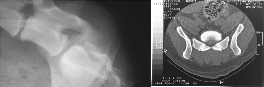 Notar o aspecto normal dos foramens intervertebrais, a presença de gordura epidural no canal vertebral e ao redor da porção terminal do saco dural Animal número 6 - São Paulo - 2008