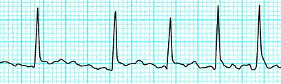 FIBRILAÇÃO ATRIAL Desordem no impulso/