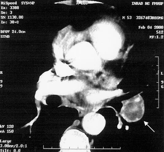 Aneurisma de artéria pulmonar como manifestação da doença de Behçet Figura 1 Tomografia computadorizada de tórax evidenciando dilatação aneurismática de artéria descendente interlobar esquerda com