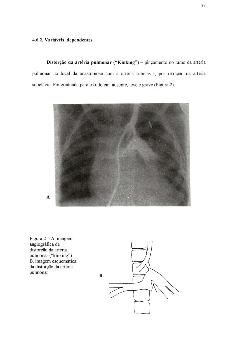 27 4.6.2. Variáveis dependentes Distorção da artéria pulmonar ("Kinking") - pinçamento no ramo da artéria pulmonar no local da anastomose com a artéria subc\ávia, por retração da artéria subclávia.
