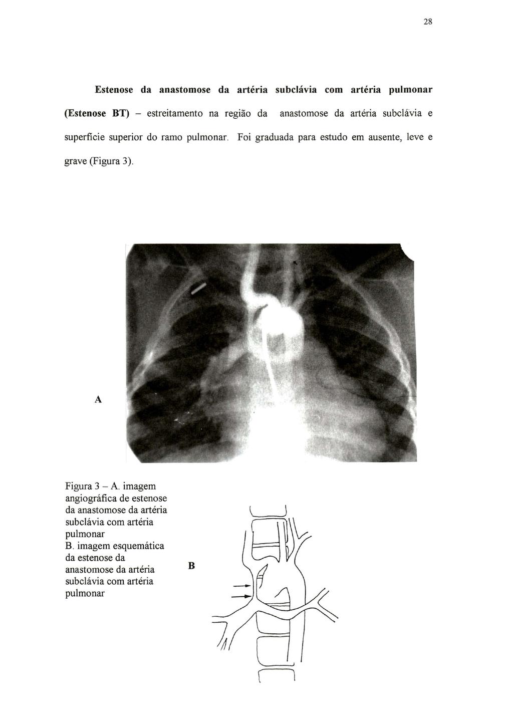 28 Estenose da anastomose da artéria subclávia com artéria pulmonar (Estenose BT) - estreitamento na região da anastomose da artéria subclavia e superficie superior do ramo pulmonar.