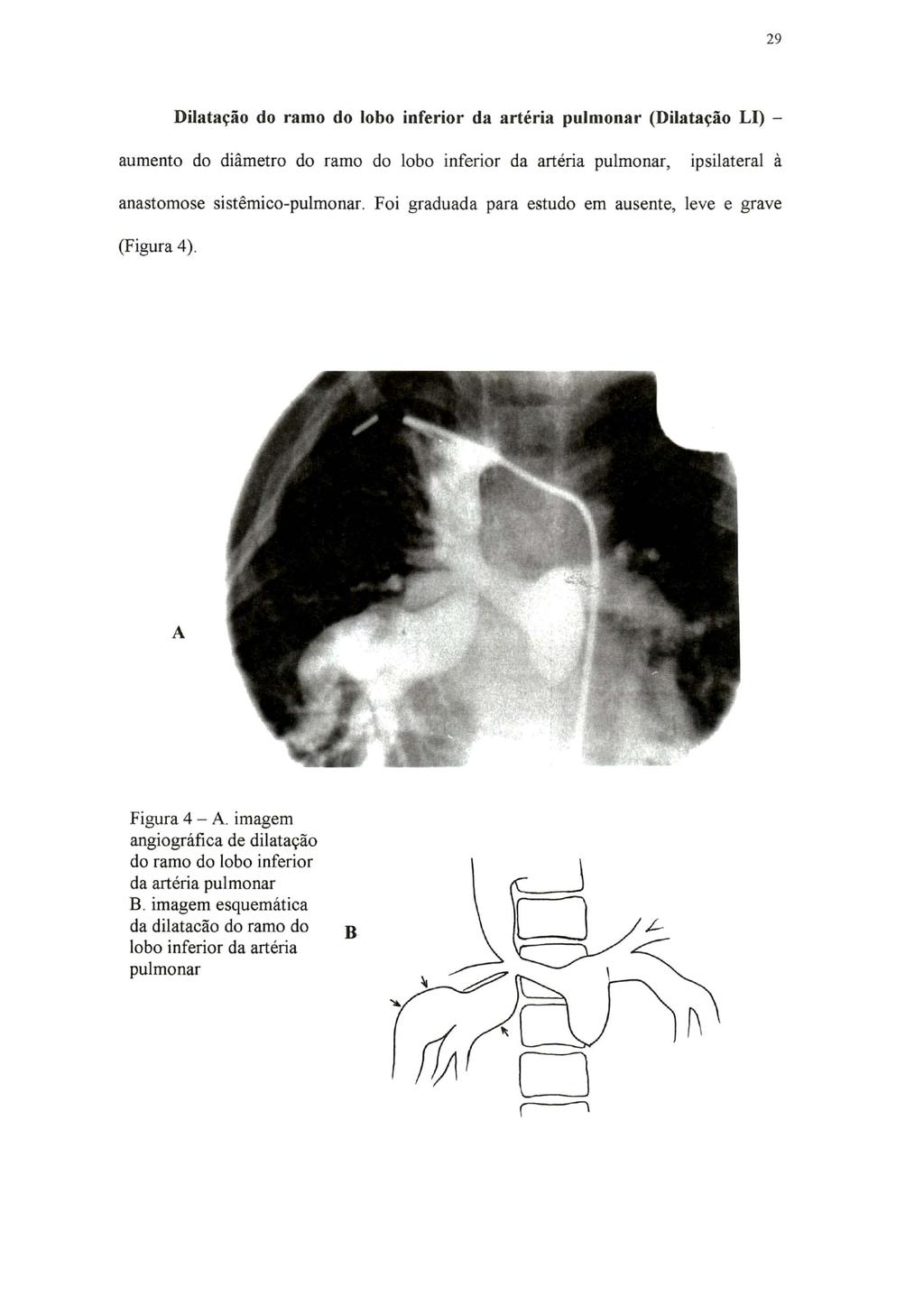 29 Dilatação do ramo do lobo inferior da artéria pulmonar (Dilatação LI) - aumento do diâmetro do ramo do lobo inferior da artéria pulmonar, ipsilateral à anastomose sistêmico-pulmonar.