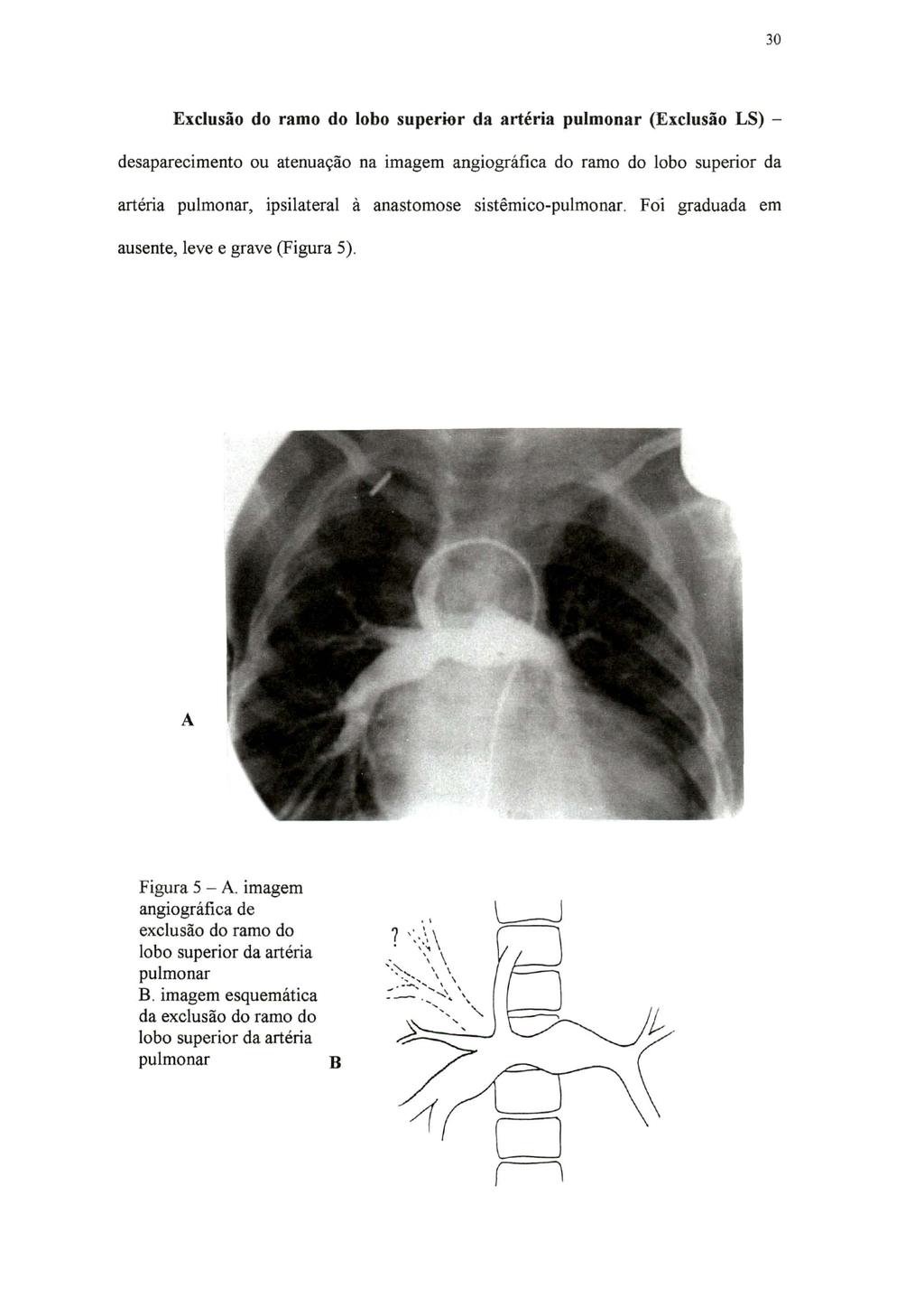 30 Exclusão do ramo do lobo superior da artéria pulmonar (Exclusão LS) - desaparecimento ou atenuação na imagem angiográfica do ramo do lobo superior da artéria pulmonar, ipsilateral à anastomose