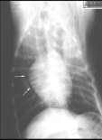 Anormalidades Pneumotórax Efusão pleural Ar livre na cavidade torácica Causas Trauma Perfuração pulmão e pleura visceral Perfuração parede torácica e pleura