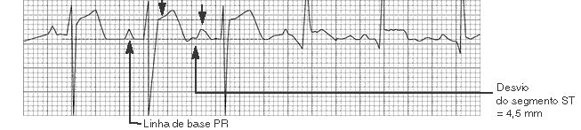Pericardite Eletrocardiograma