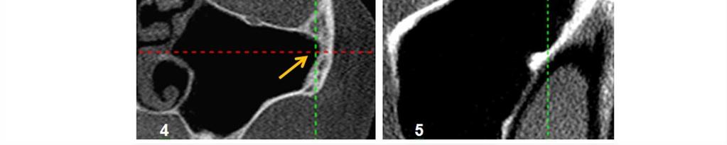 Reconstrução coronal de extensão para zigomático do SM, observar concavidade feita no osso zigomático. Figura 5.