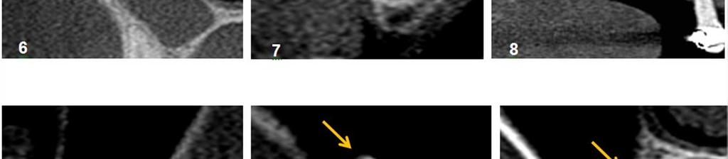 Reformatação sagital evidenciando uma área compatível com cisto de retenção de muco, lado direito. Figura 9.